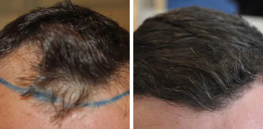 How Much Does A Receding Hairline Transplant Cost?