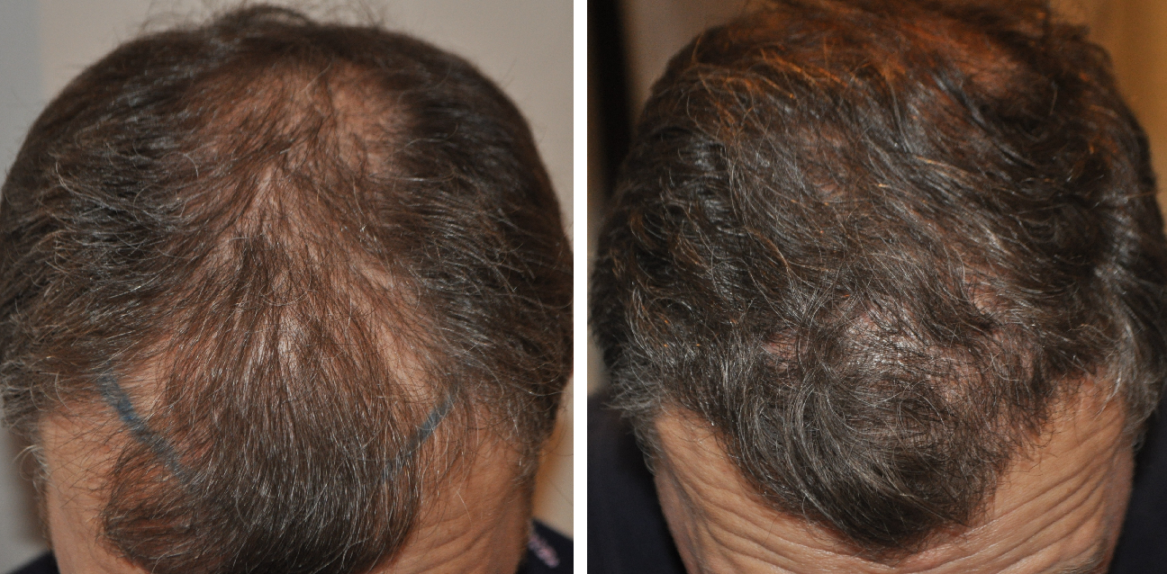 before and after 1600 grafts FUT hair transplant