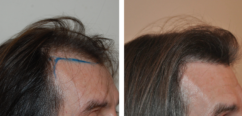Norwood Stage 4: Photos, Treatments, Results, Wimpole Clinic