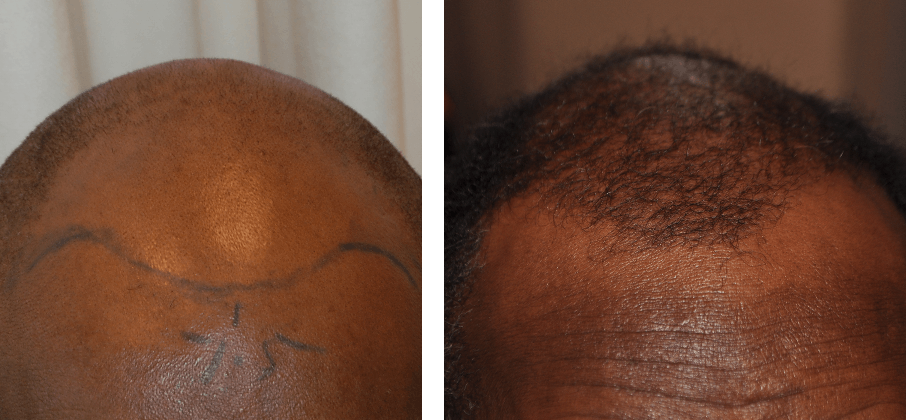 before and after 2200 graft hair transplant
