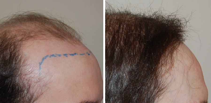 before and after 4200 graft hair transplant