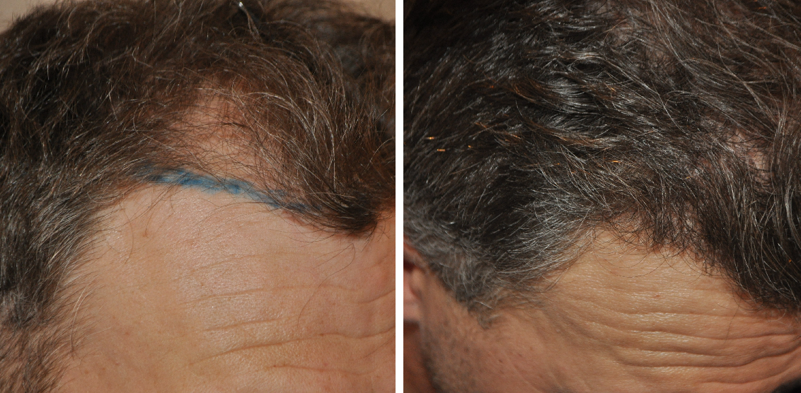 Hair Transplant - BRITS MEDICAL AND COSMETIC SERVICE LIMITED