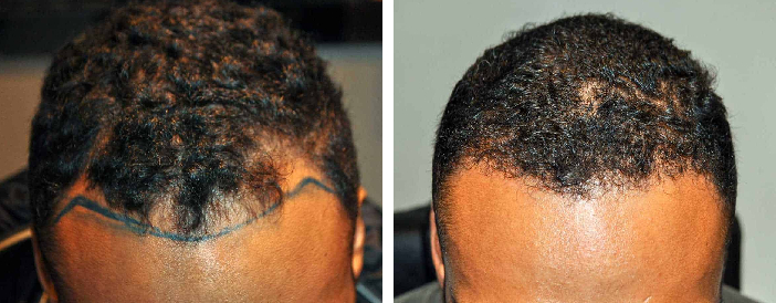 before and hair growth after 500 graft hair transplantation