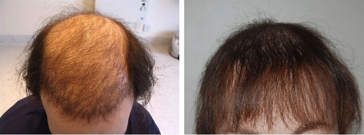5000 Grafts Hair Transplant: Coverage, Costs, Results, Wimpole Clinic