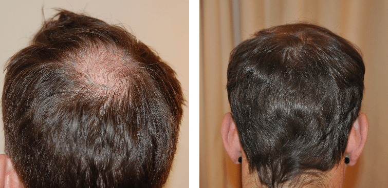 before and after 800 graft hair transplant procedure
