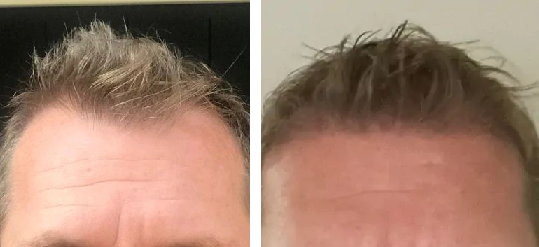 before and 10 months after transplant
