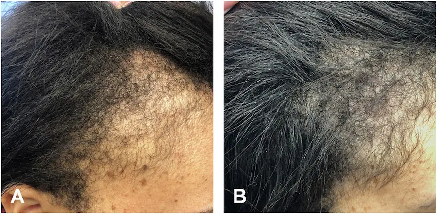 before and after Minoxidil treatment