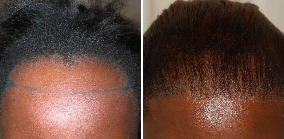 before and after afro hair transplant