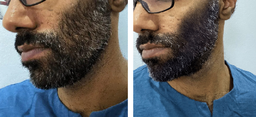 before and after beard fibres