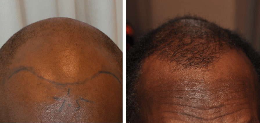 Patient before and 6 months after hair transplant surgery