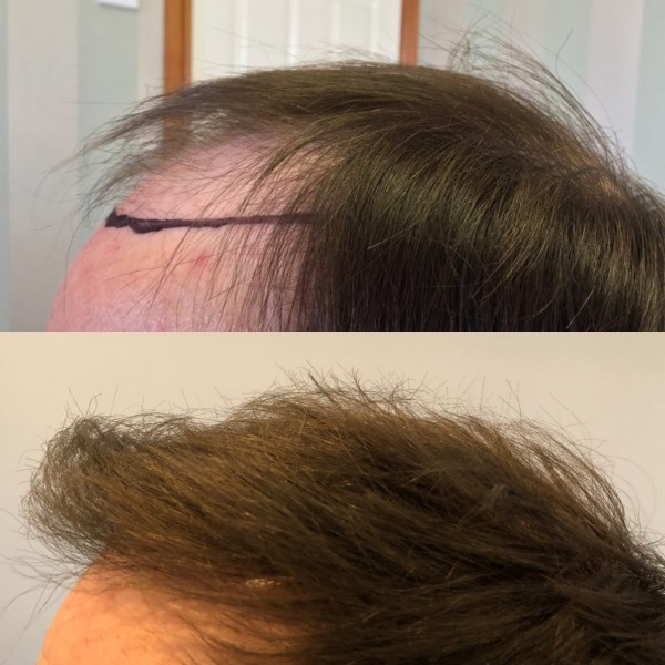 before and after hair transplant with Dr. Harris Haseeb