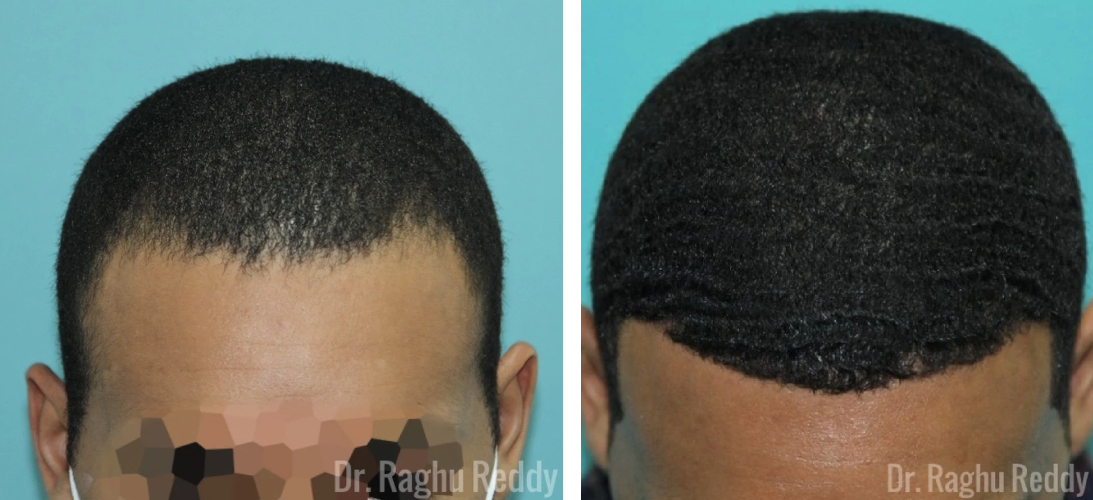 before and after hair transplant with Dr. Reddy