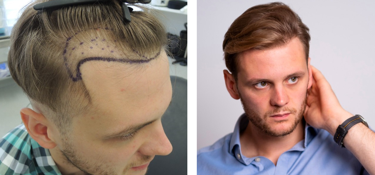 before and after hair transplant with Dr. Tam