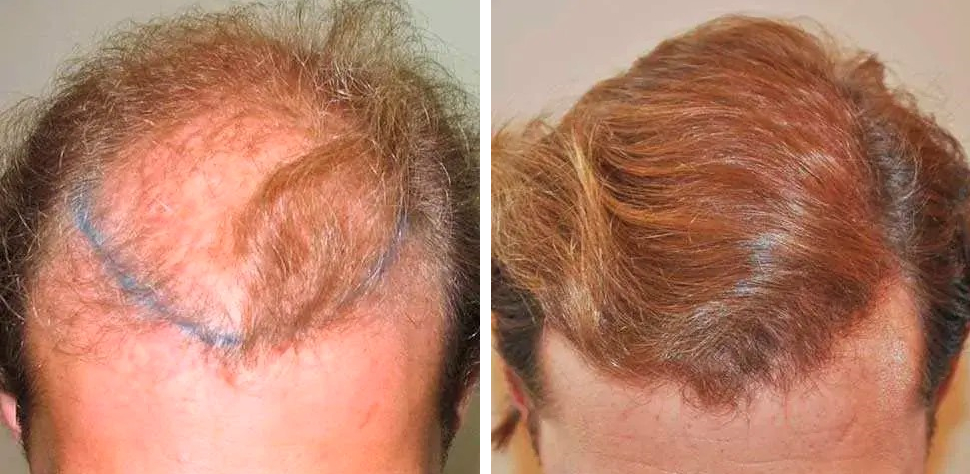 before and after hair transplant with Dr. Ughratdar