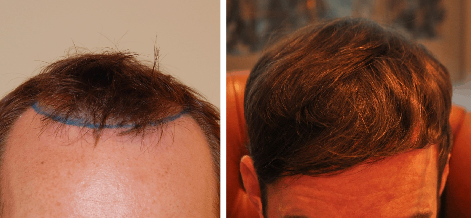 before and after hair transplant with Dr. Zareie