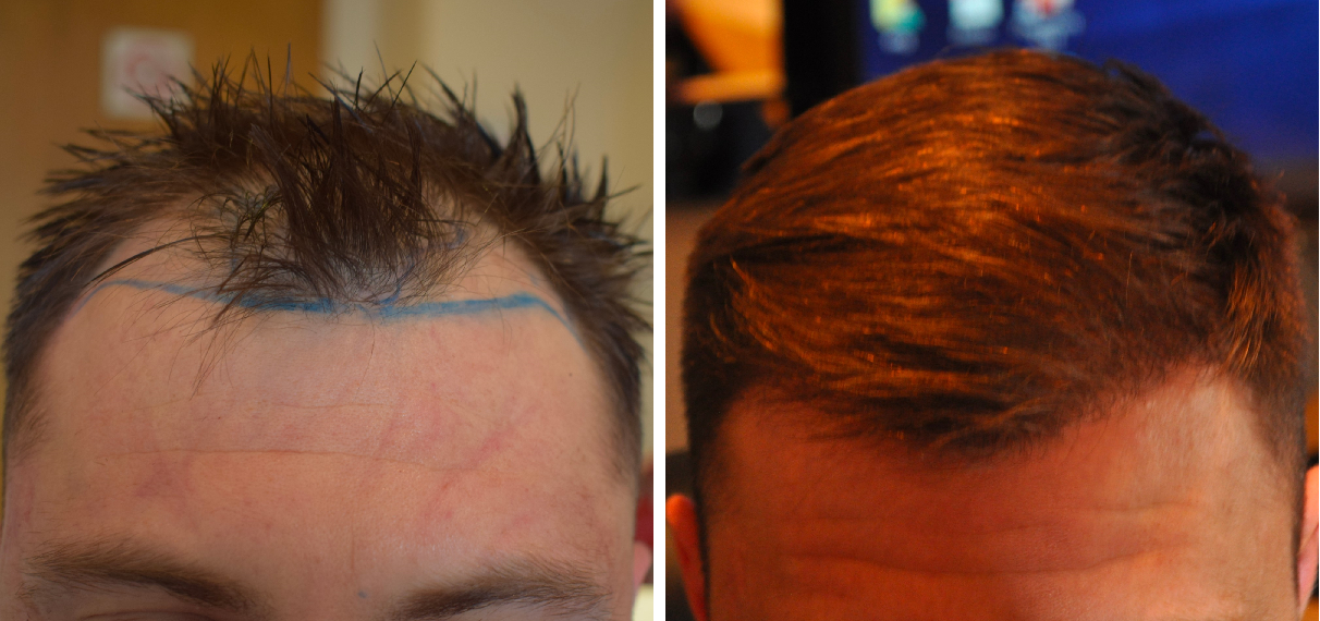 The Best Hair Loss Treatment For Men, Wimpole Clinic