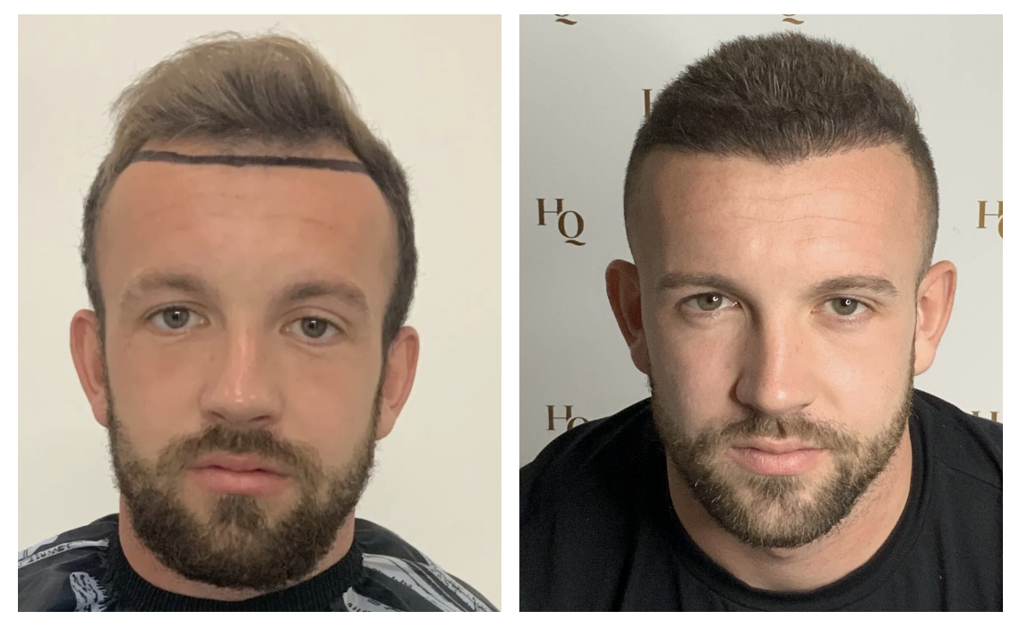 before and after hair transplants at Head Quarters Hair Transplants Clinic