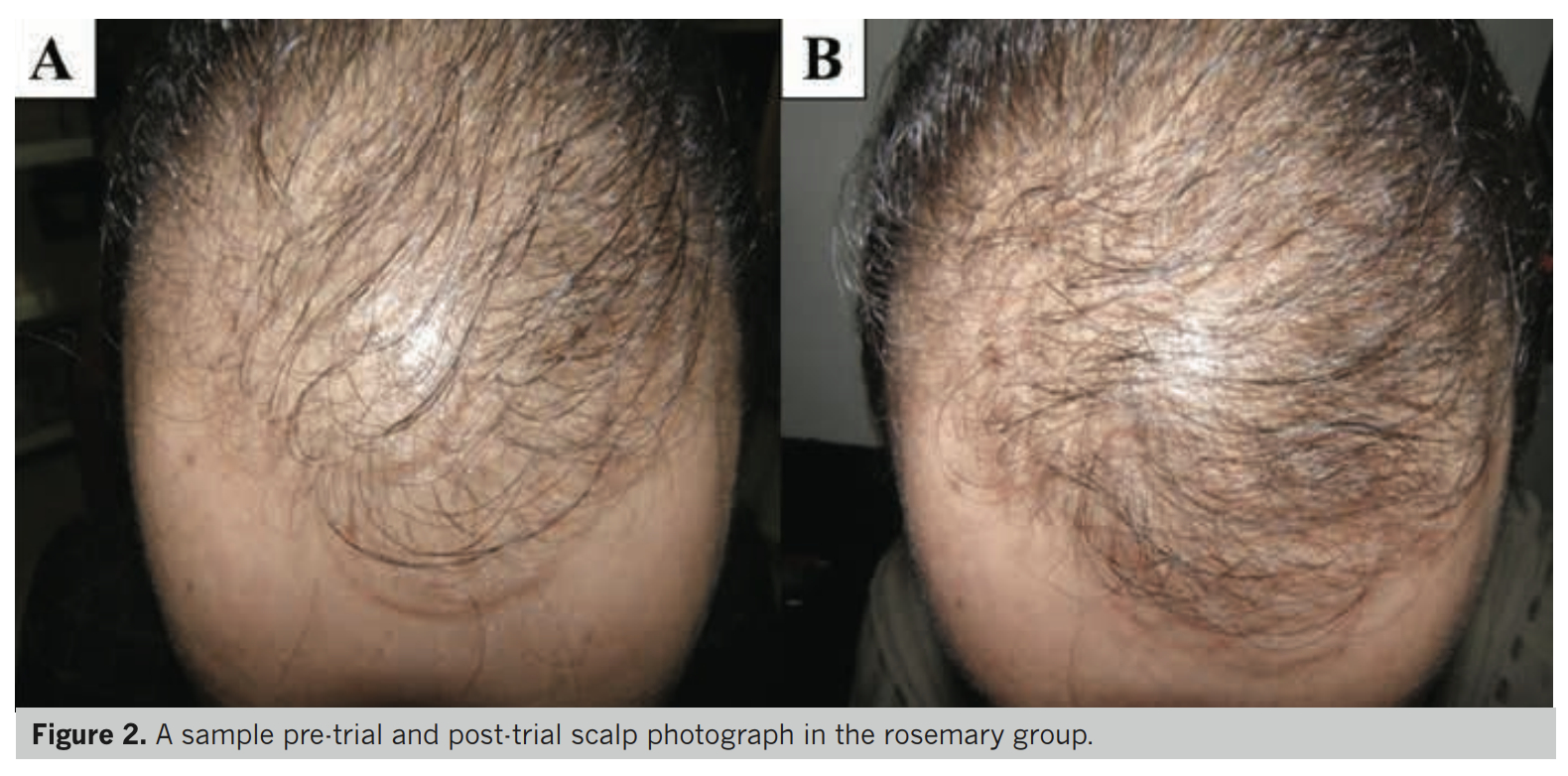 before and after results of using rosemary oil