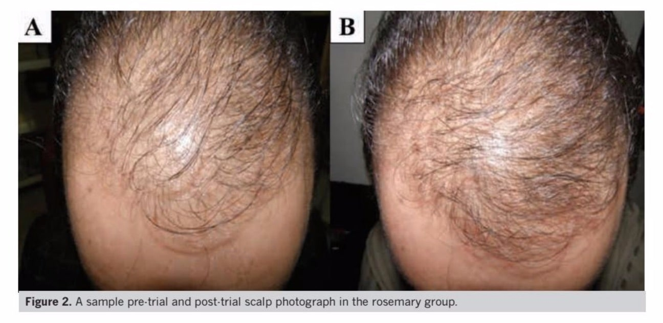 before and after using rosemary oil for hair growth