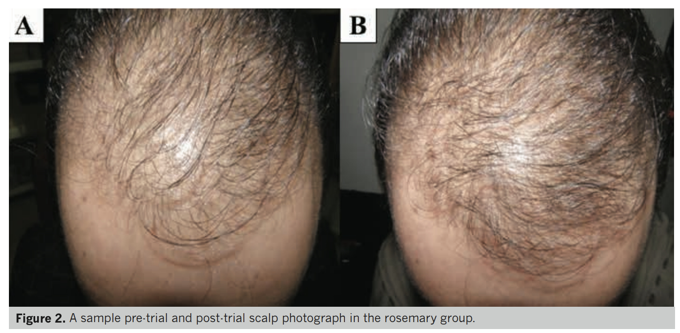 before and after using rosemary oil for hair growth