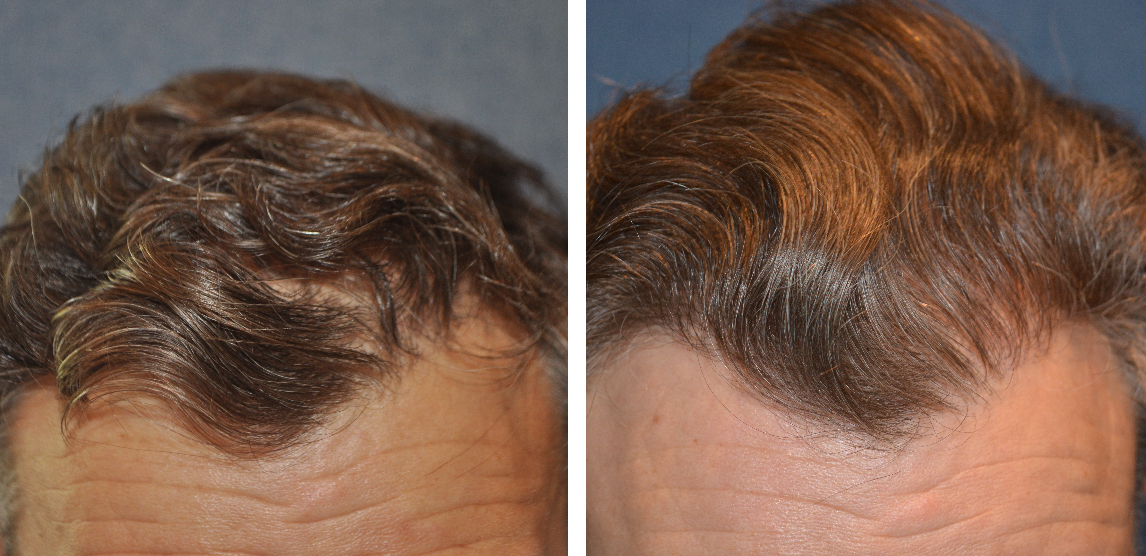 Hair Transplants For Curly &#038; Wavy Hair, Wimpole Clinic