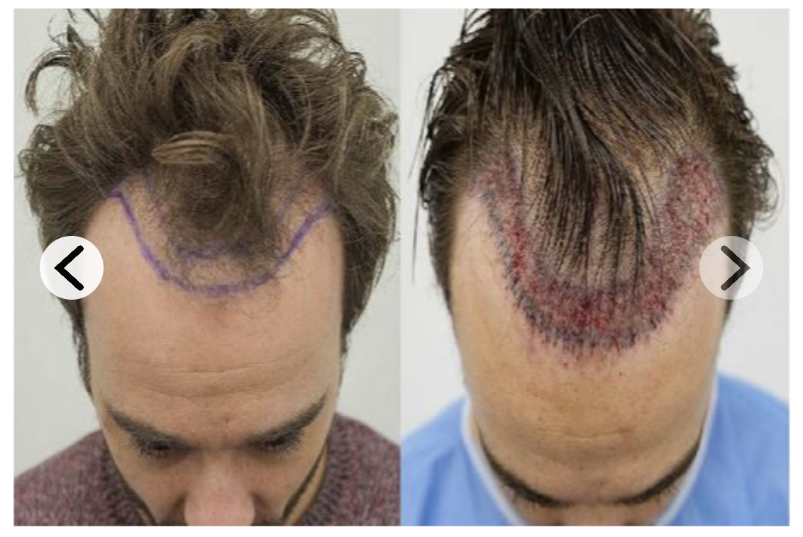 before and soon after hair transplant results