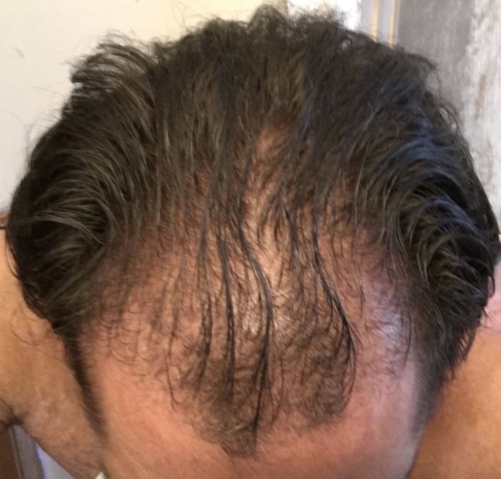 before finasteride 9 months use