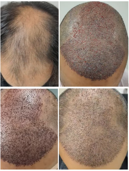 before, immediately after, 1 day, and 10 days after hair transplant