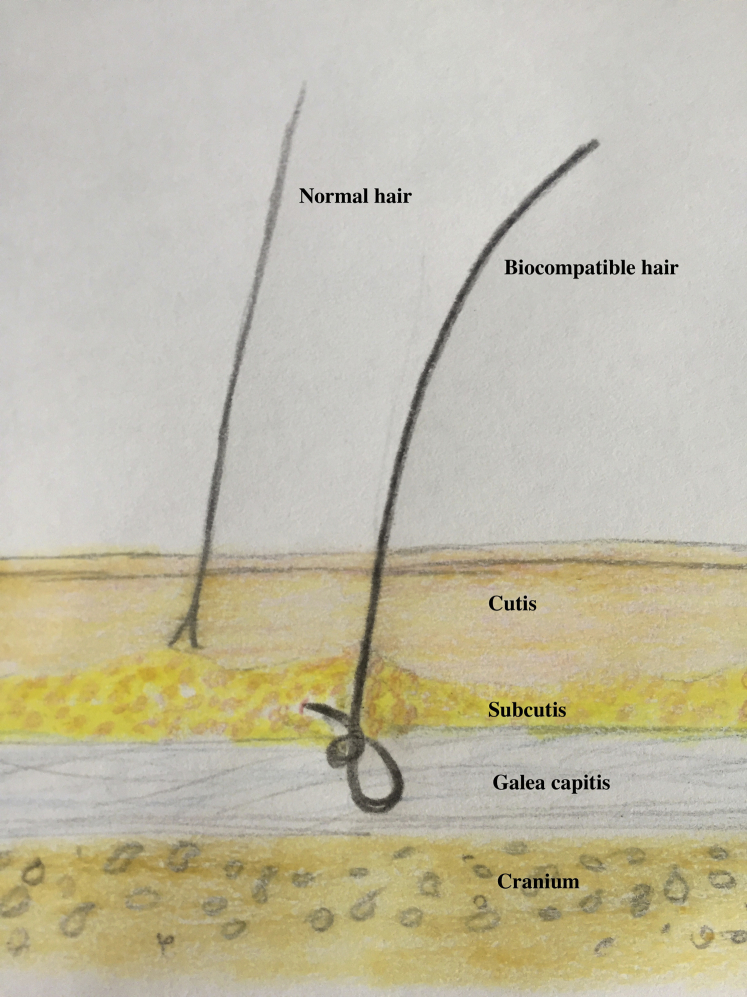 biofibre depth vs normal hair follicle