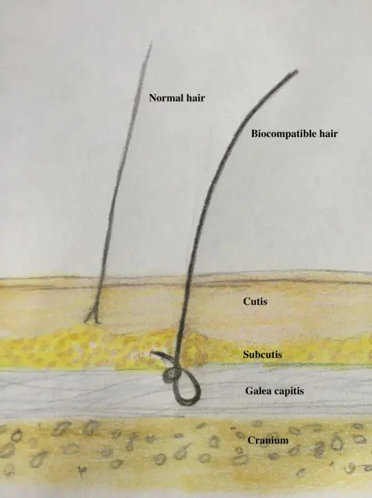 picture depicting how deep the biofibres go into the scalp