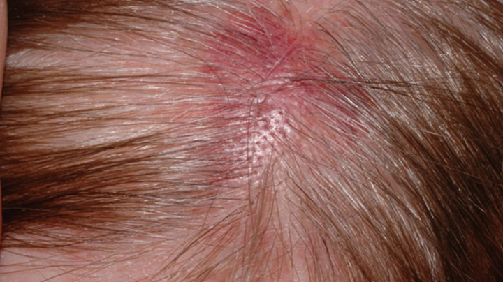 Recurring Scab On Scalp In The Same Spot: Causes, Prevention, Treatment