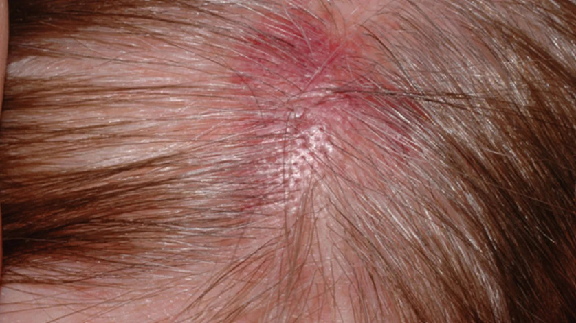 Recurring Scab On Scalp In The Same Spot: Causes, Prevention, Treatment ...