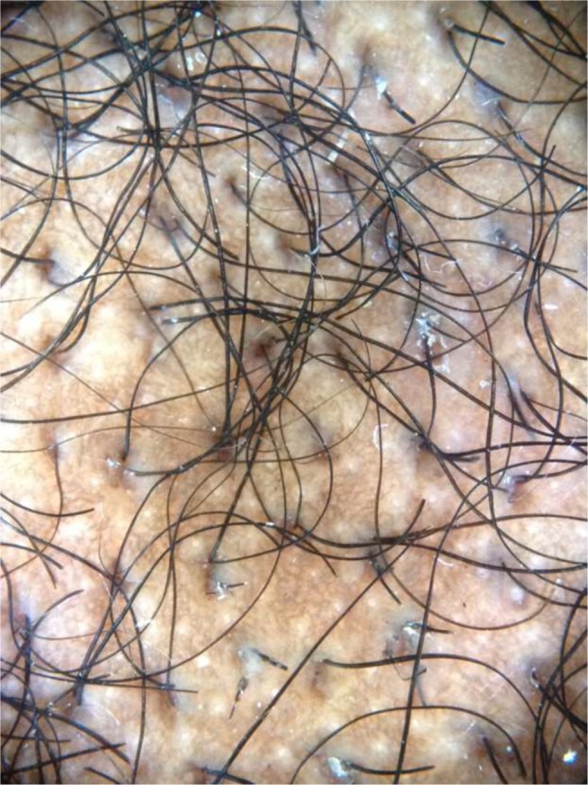 broken hairs and black dots traction alopecia close up
