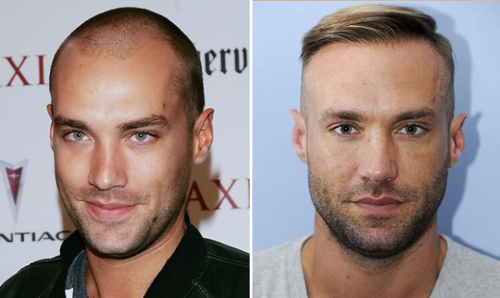 calum best before and after celebrity hair transplant