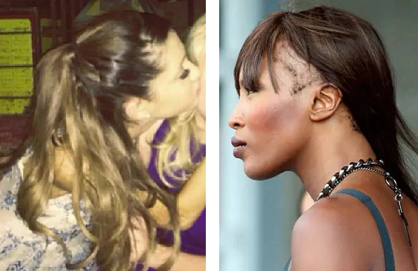 celebrity examples of traction alopecia