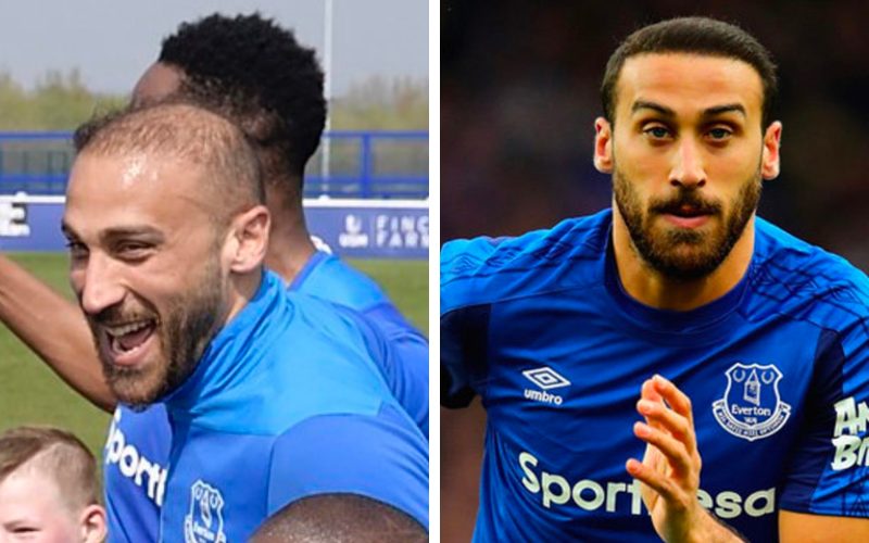 Cenk Tosun's hairline before and after