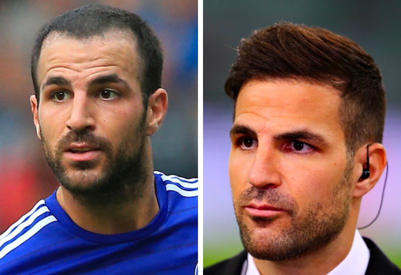 Cesc Fabregas before and after new hairline