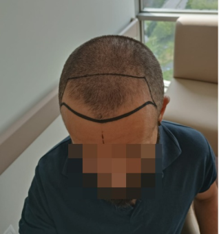 patient before botched hair transplant