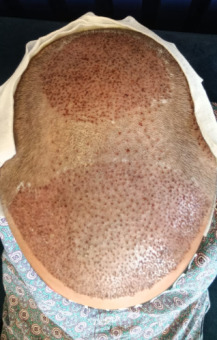 after photo of a botched hair transplant