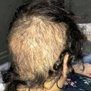 Example of an over-harvested hair transplant