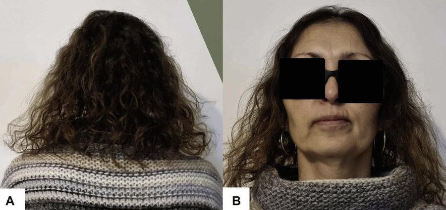 Patient after taking oral Minoxidil medication to regrow hair after chemotherapy