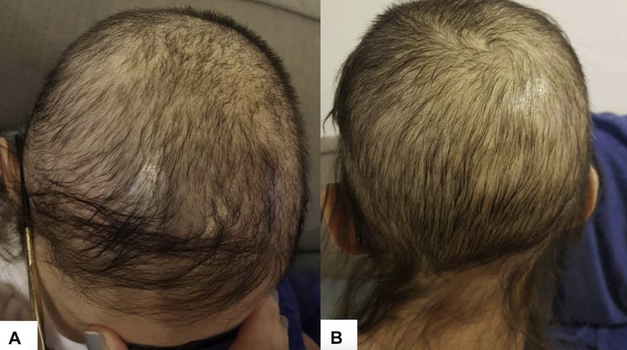 rogaine results timeline