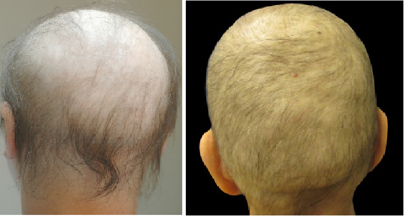 examples of hair loss due to chemotherapy