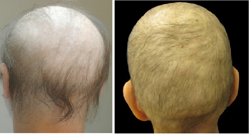 Chemotherapy induced hair loss (anagen effluvium)