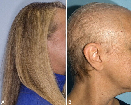 chemotherapy induced hair loss