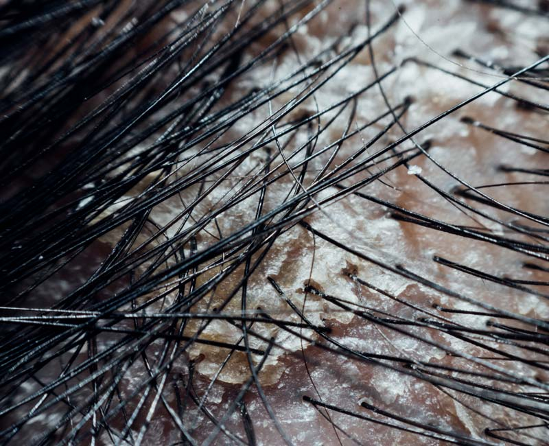 close up image of a dry and flaky scalp
