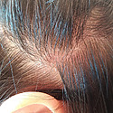 Can A Dry Scalp Cause Hair Loss? Prevention & Treatment Tips