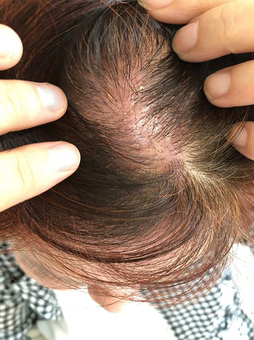 23 Causes Of An Itchy Scalp According To The Nhs