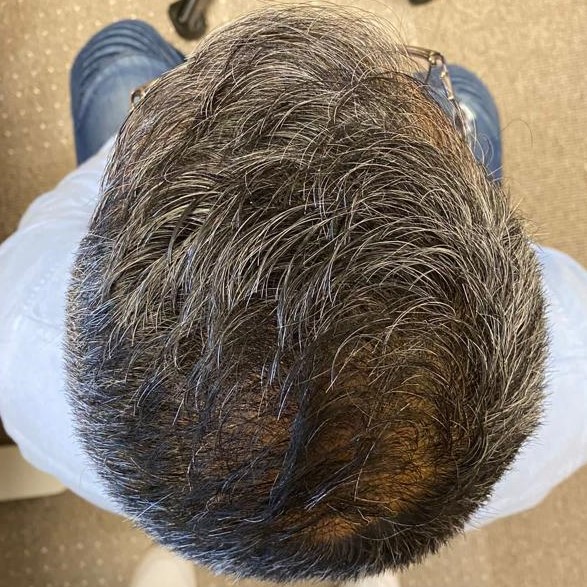 FUE Hair Transplant, Wimpole Clinic