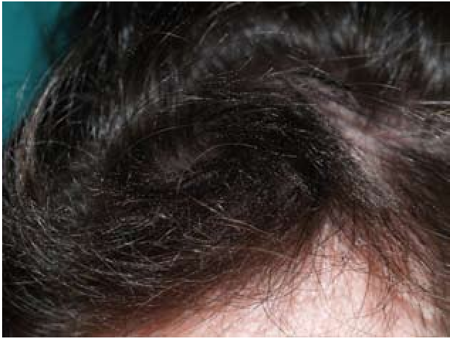 hair damage caused by excessive brushing